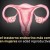 Mujeres con síndrome de ovario poliquístico son propensas a depresión y ansiedad