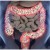 Relación intestino-cerebro redefine tratamiento del síndrome de intestino irritable